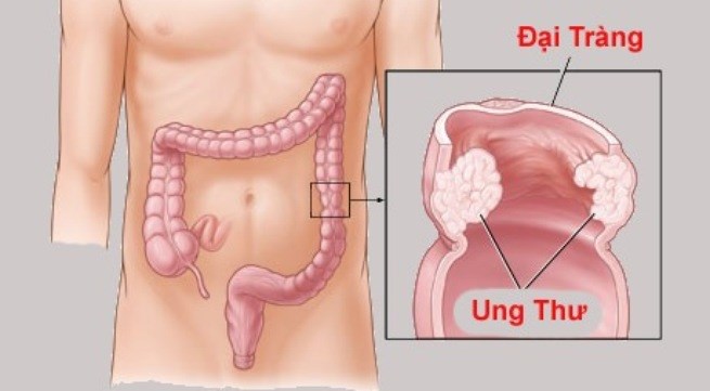 Polyp đại tràng : Nỗi sợ sệt của người mắc bệnh không may mang “sát thủ ung thư”