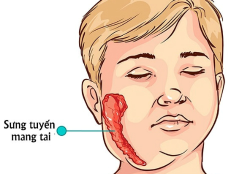 Nhận biết và xử trí khi mắc bệnh quai bị