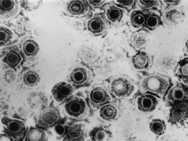 Táo bón là do vi trùng … herpes