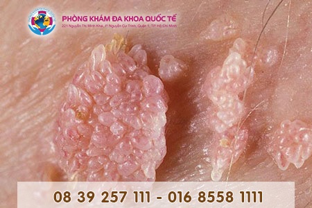 Cánh mày râu chớ nên coi thường virus HPV gây sùi mào gà